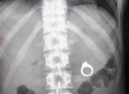 s-XRAY-ENGAGEMENT-large Do not hide rings in food! Photo courtesy of Huffington Post.